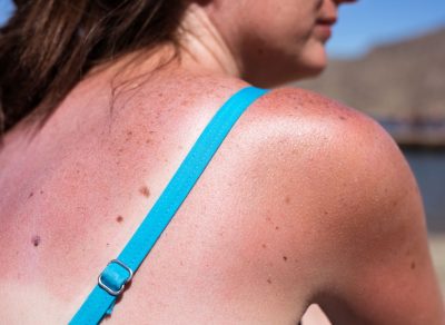 How to Heal Your Sunburn With Food