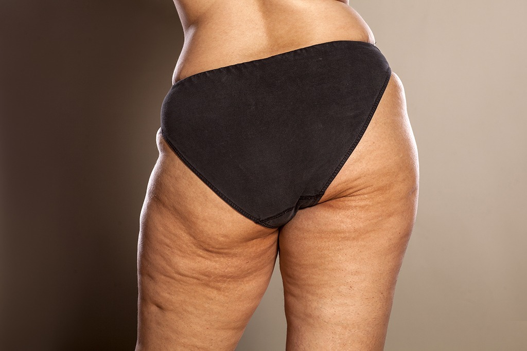 Woman cellulite.jpg