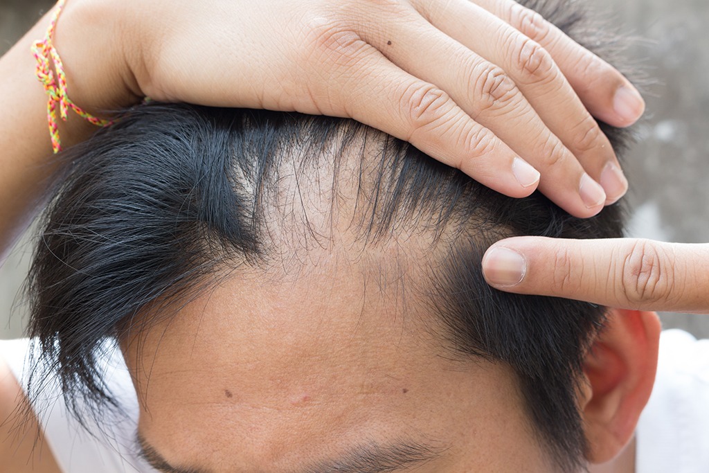 balding man hair loss