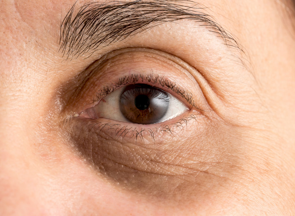 Woman with dark eye circles