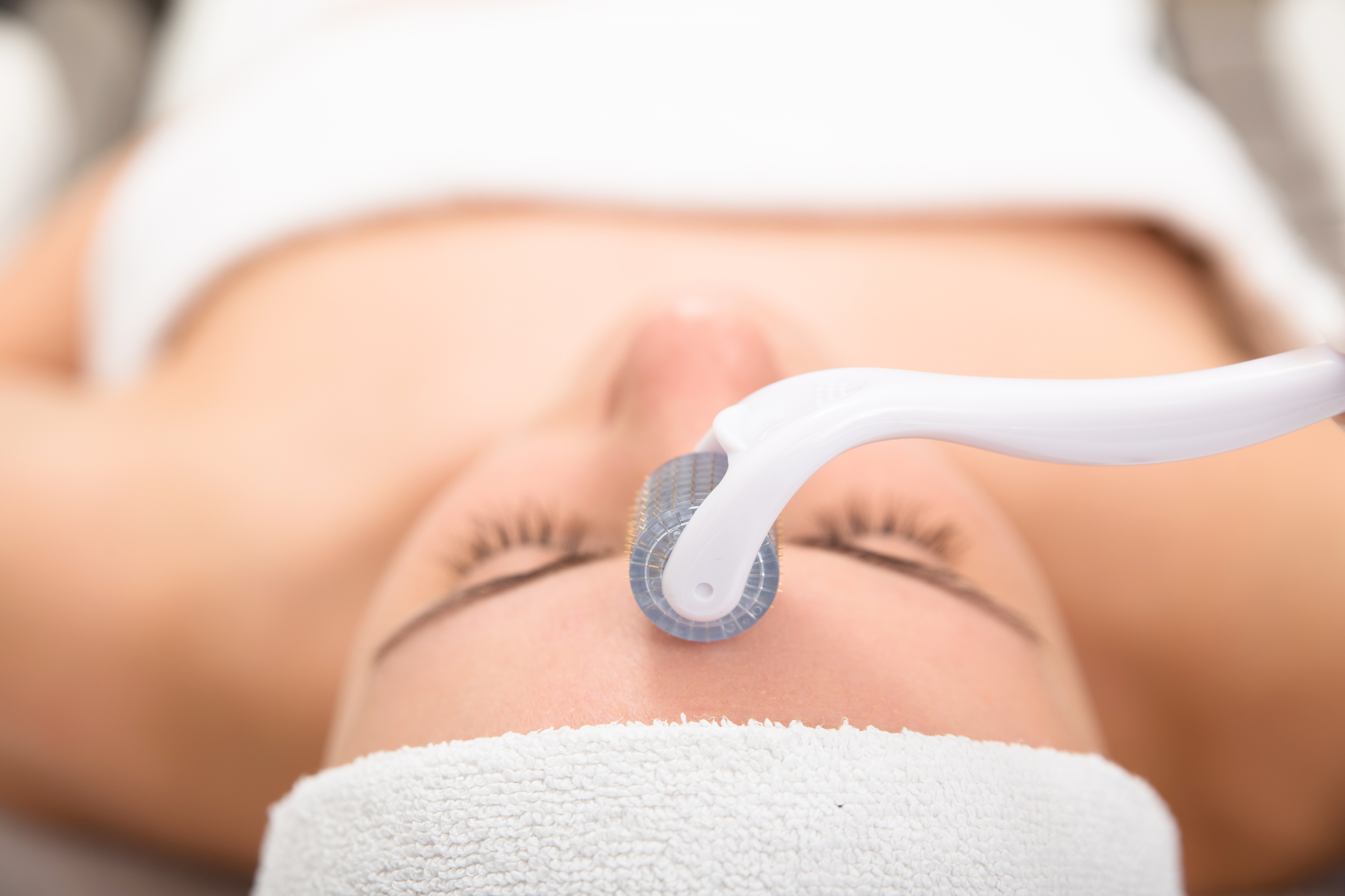 Microneedling