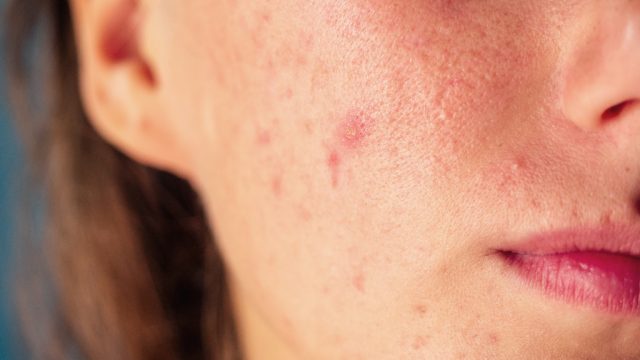 13 Foods Dermatologists Say Make Your Skin Worse Eat This Not That