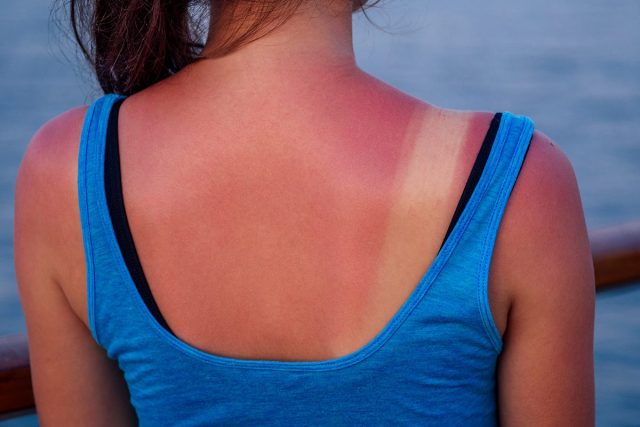 a woman's sun burned back