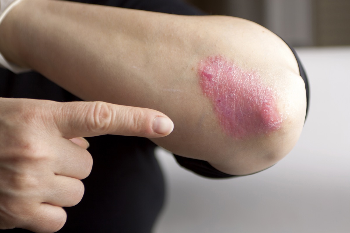 Psoriasis on elbow