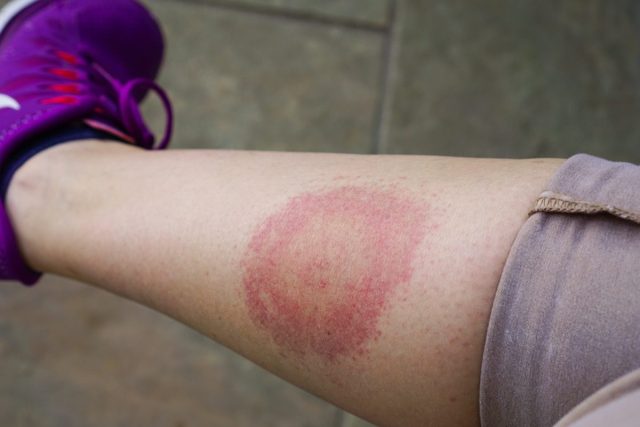 A person, leg bitten by a deer tick
