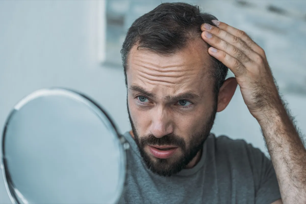 man with hair loss looking at mirror