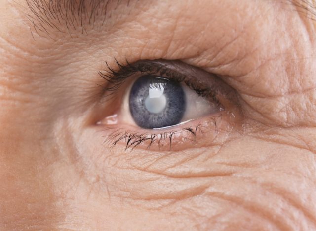 Cataract concept. Senior woman's eye