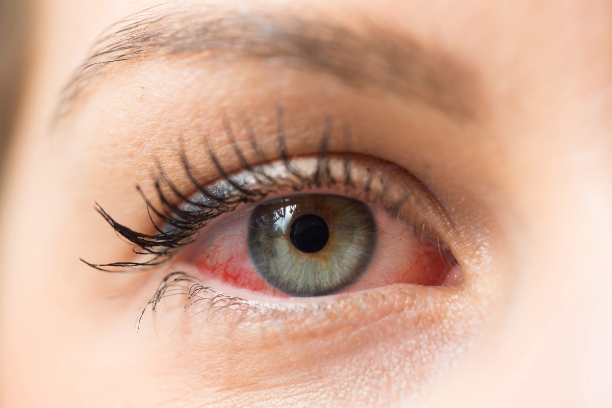 Red eye for allergy
