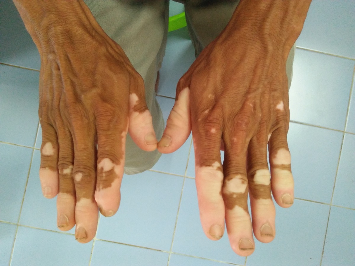 Male hand Skin disorder pepper appearance from vitiligo,scleroderma and raynaud, medical concept autoimmune disease