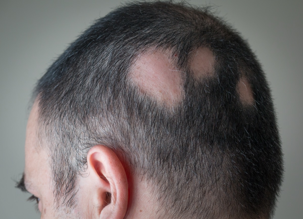 Alopecia Aerata - Spot Baldness
