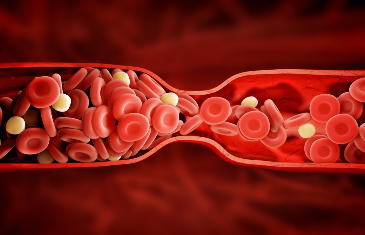 causes of blood clotting in brain