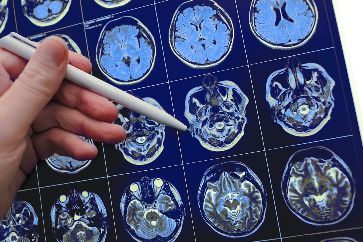 Médico apuntando con lápiz al problema cerebral en el resultado del estudio de resonancia magnética