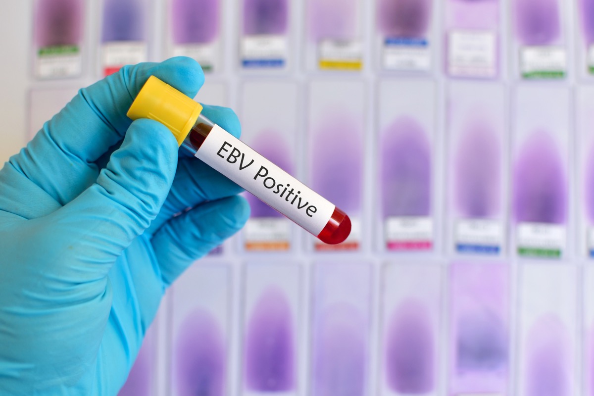 Blood sample positive with Epstein-Barr virus (EBV)