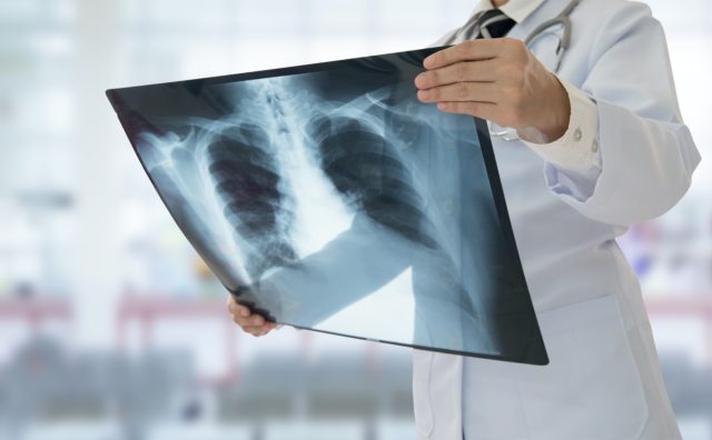 Doctor examining chest x-ray film of patient at hospital