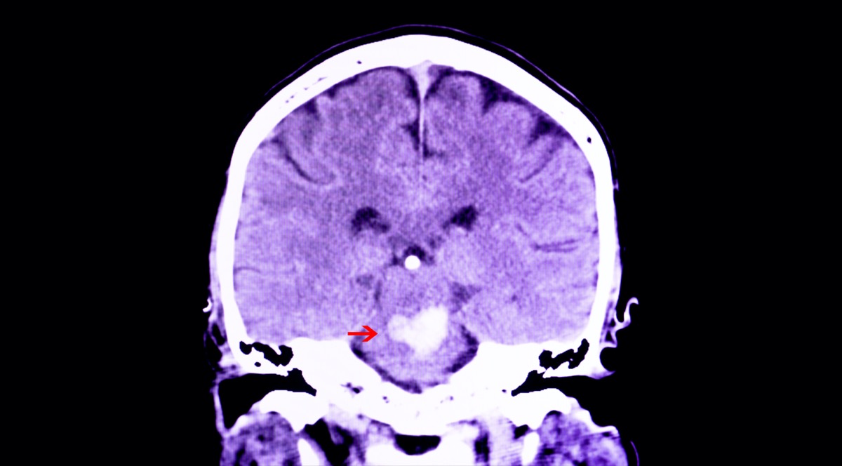 CT scan of the brain of a patient with intracranial hemorrhage
