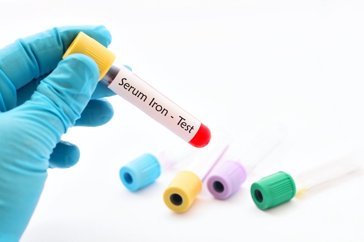 Blood sample for serum iron (SI) test, diagnosis for anemia disease