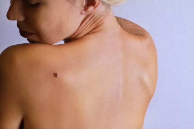 Young woman looking at birthmark on her back, skin. Checking benign moles.