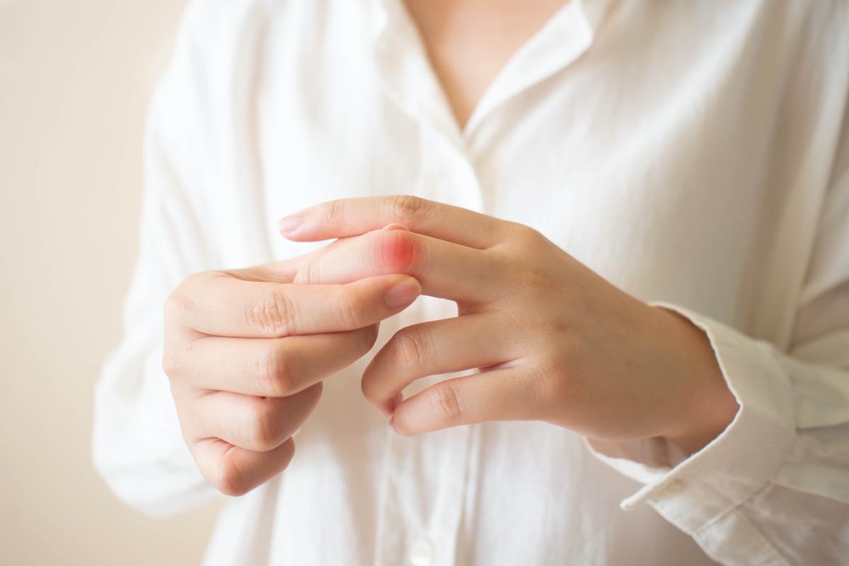 Young female suffering from hand and finger joint pain with redness.