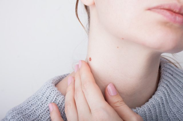 Chica con marcas de nacimiento en el cuello