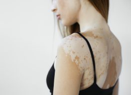 female model in black tank top suffering from vitiligo disorder