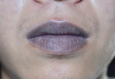 Cyanotic lips or central cyanosis at Southeast Asian, Chinese young man with congenital heart disease.