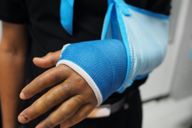 A plaster cast with plaster.
