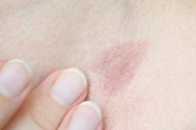 skin rash treatment on woman neck