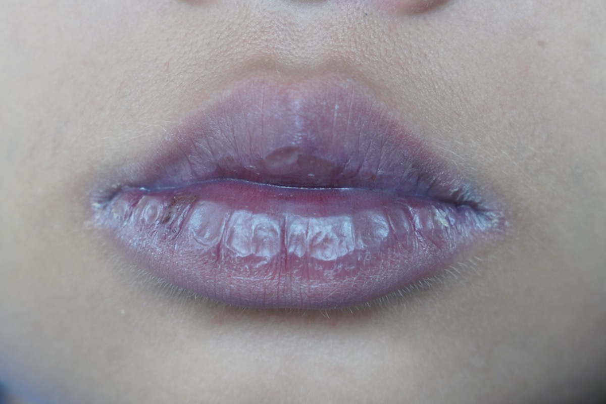 Dark purplish lips color in congenital cyanotic heart disease girl patient.