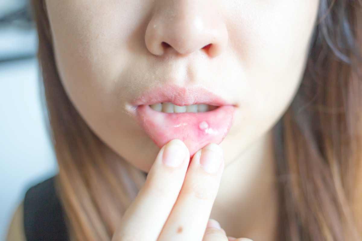 Woman with aphthae on lip.