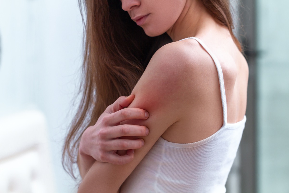 Woman rash shoulder