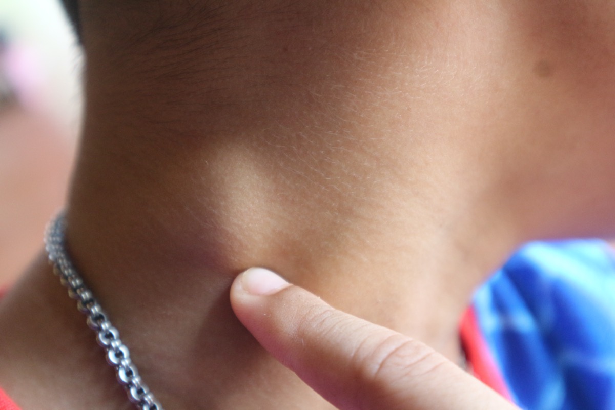 Children neck lymph node inflammation (lymphadenitis) is disease of is an infection