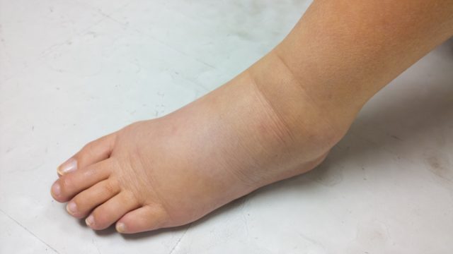 edema of leg and foot