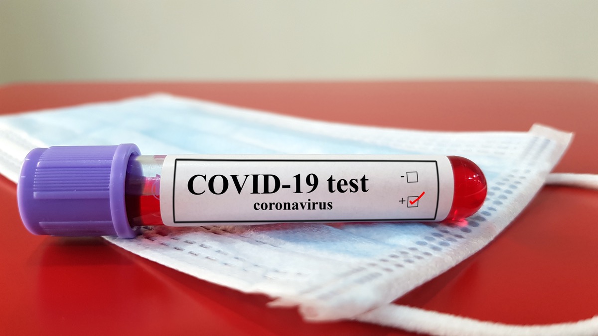 Positive COVID-19 test and laboratory sample of blood testing for diagnosis new Corona virus infection