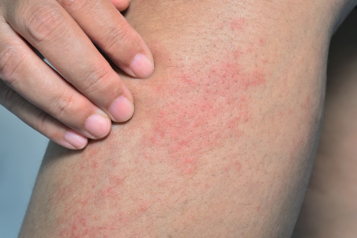 rash on the woman leg skin
