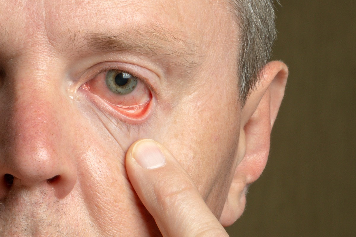 male eye with reddened eyelid and cornea, conjunctivitis