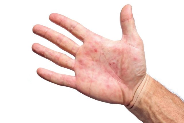 Palm patient erythema in red in ulcers from inflammation.
