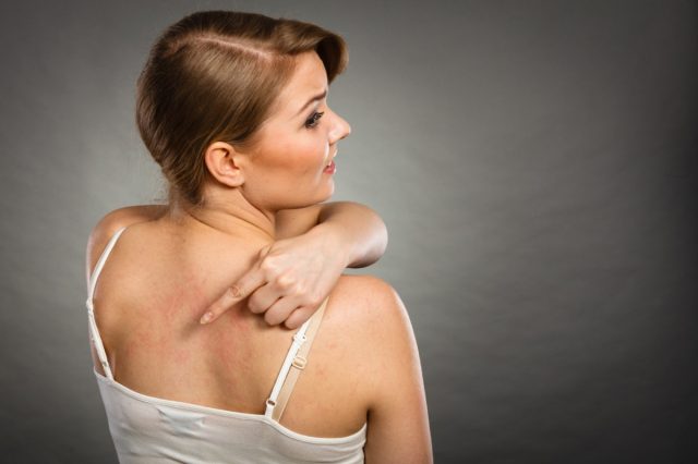 woman showing her itchy back with allergy rash urticaria symptoms