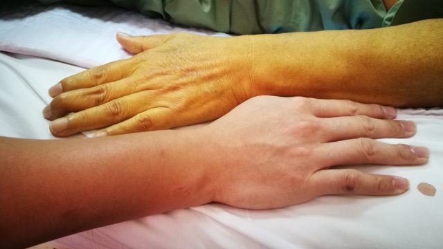 Jaundice patient with yellowish discoloration of skin in comparison with Normal Skin color.
