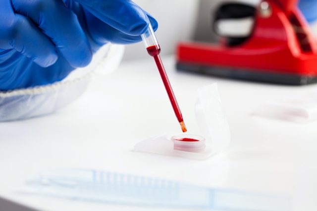 Investigación de laboratorio del virus Corona COVID-19, científico que examina la muestra de sangre bajo el microscopio, cierre de la pipeta manual, investigación de sangre entera convaleciente para un posible tratamiento con plasma rico en plaquetas