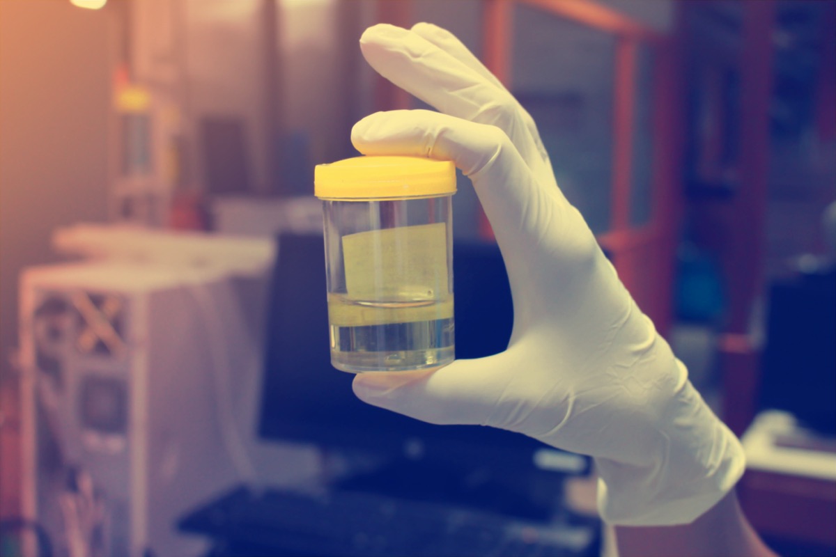 Urine sample and urine analysis