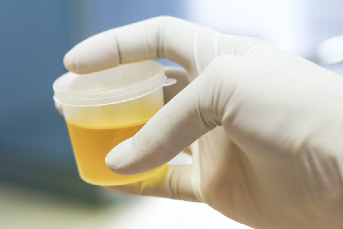 Medical urine test, close-up