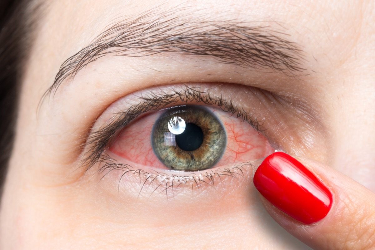 Woman pink eye