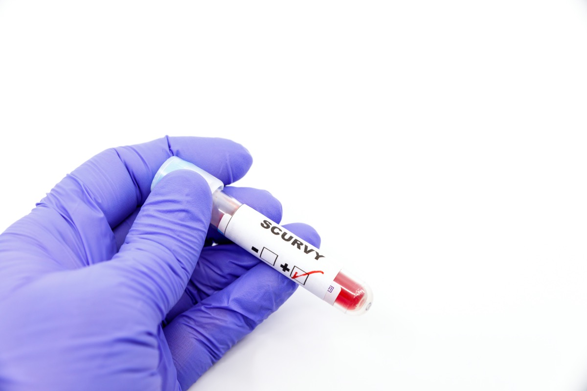 Closeup of microbiologist or medical worker hand with blue surgical gloves marking blood test result as positive for the scurvy