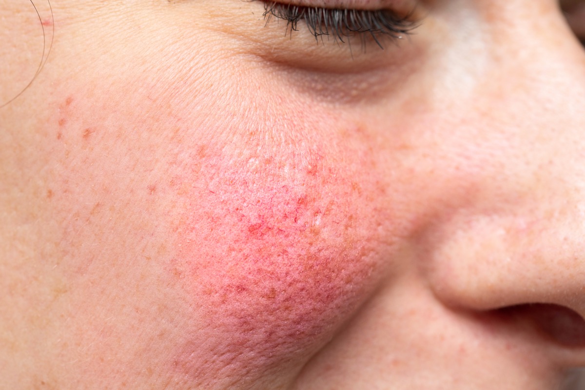 woman with rosacea on her cheeks