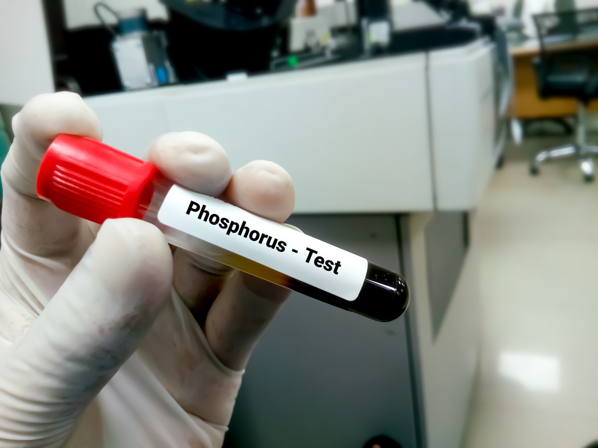 Blood sample tube for Phosphorus test. 