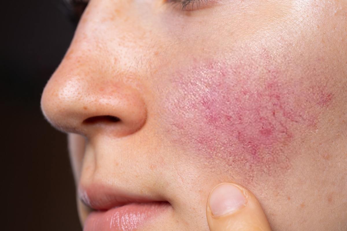 woman with rosacea on cheeks