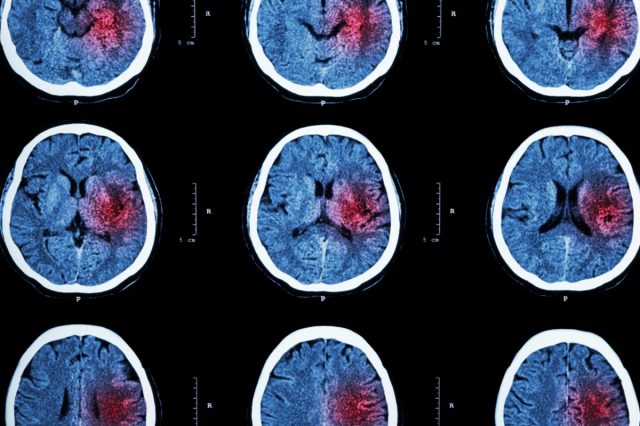 Tomografía computarizada del cerebro con área roja para accidente cerebrovascular hemorrágico