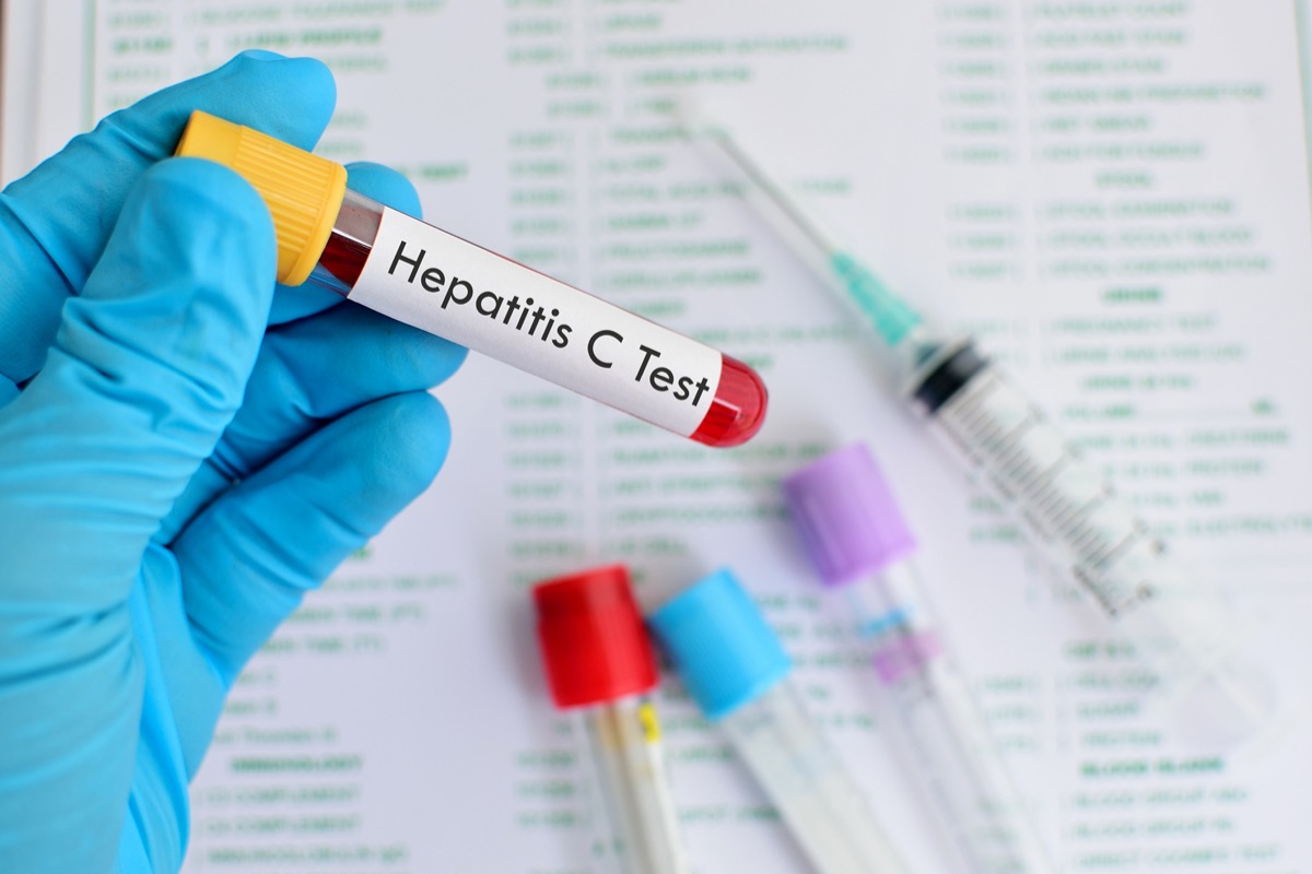 Blood sample for hepatitis C virus (HCV) testing