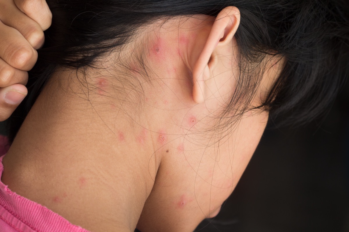Woman's neck with blisters scar and rash caused by chickenpox