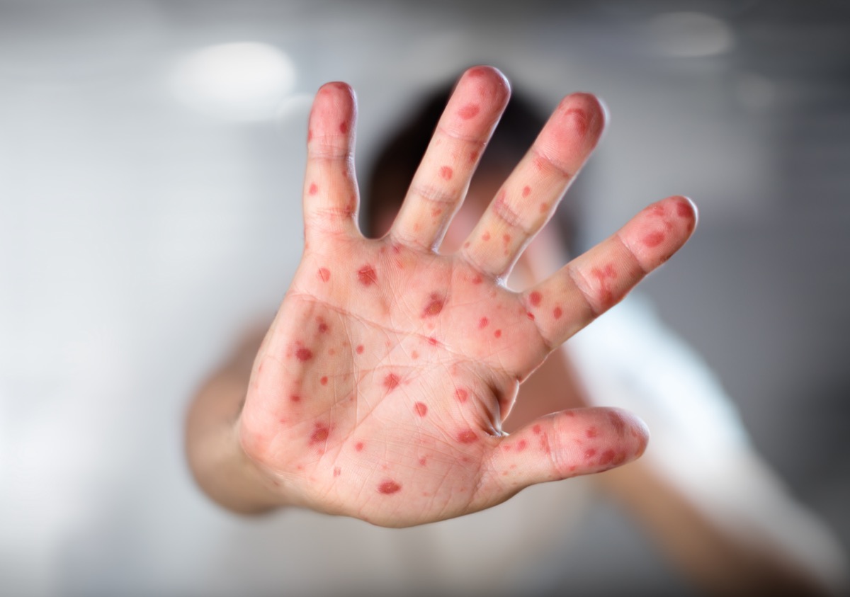Hand foot and mouth disease
